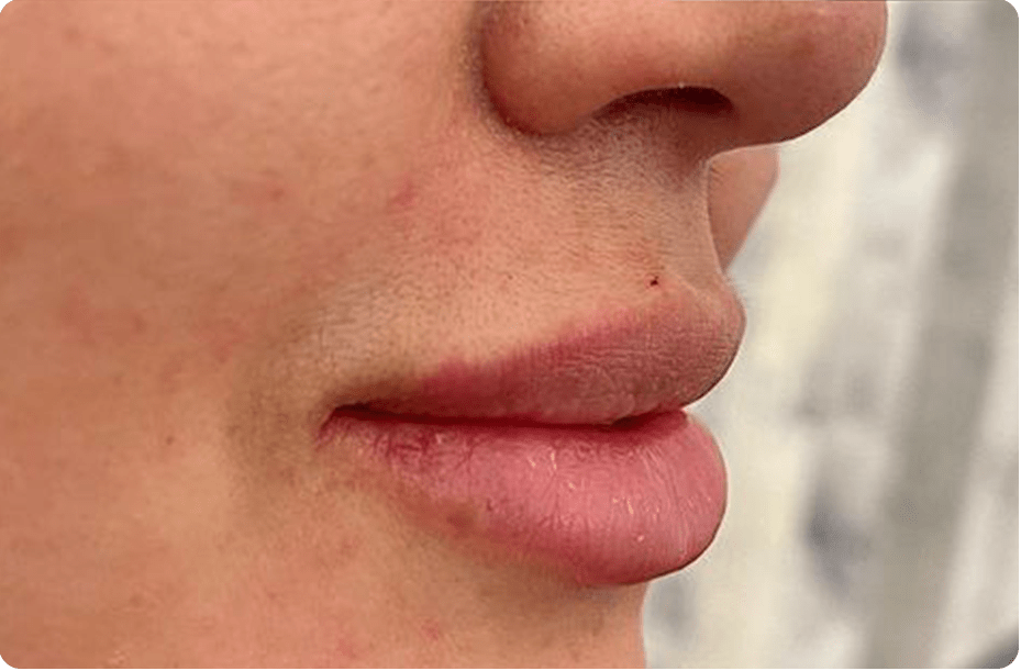 LIP FILLER